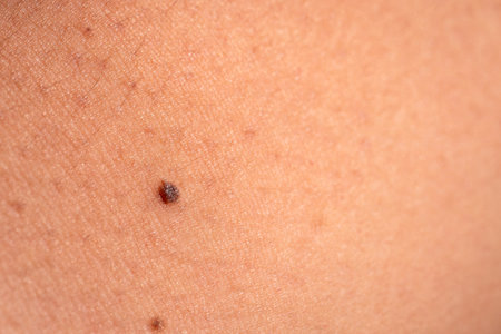 Explore the significance of moles skin and their health implications in a detailed close-up view.の写真素材