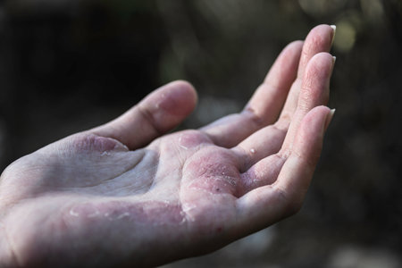 Skin healthy care. Seborrheic Dermatitis on hand in young woman.の写真素材