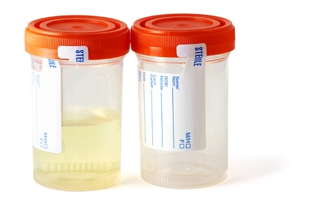 One empty an sterile specimen collection bottle, the other bottle is filled with urine, ready for...