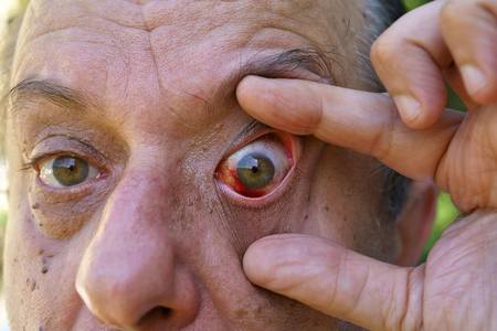 Eye, bloodshed to the eye, warts and papillaの写真素材