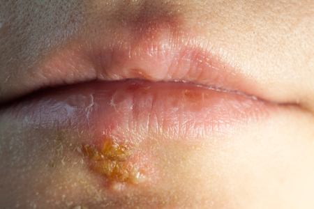 Herpes disease on the lips of a young girlの写真素材