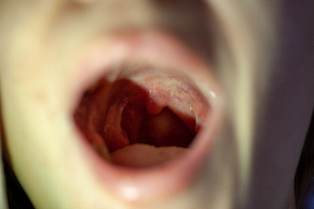 Sore throat closeup view inside mouth. Medical examination pharynx and tonsils. Red blisters in the throat. Throat, tongue and the top of mouth.