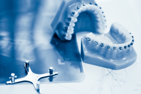 orthodontic tools in laboratory blue tonedの写真素材