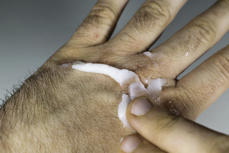 Close view of puting moisturiser cream on dry and cracked hand knuckles, skin problemの写真素材