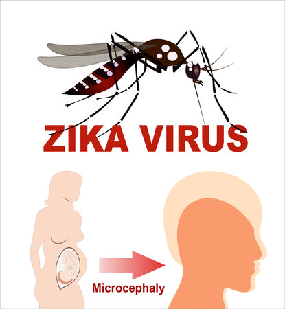 Microcephaly or Abnormal Smallness of the Head Concept. The Zika Fever Virus is linked to microcephaly birth defect cases from pregnant women bitten by Aedes aegypti mosquitoes.のイラスト素材