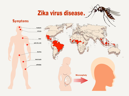 Zika virus symptoms infographics with figures and textのイラスト素材