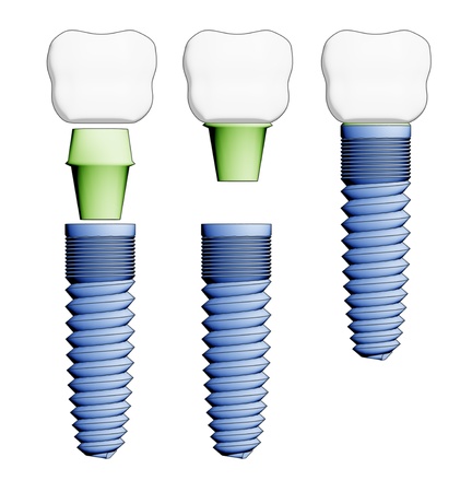 Dental implant. Schematic elements view. Isolated on white.の写真素材