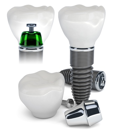 Technology of tooth implants isolated on whiteの写真素材