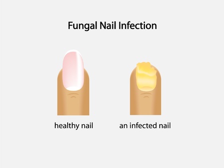 fungal nail infectionのイラスト素材