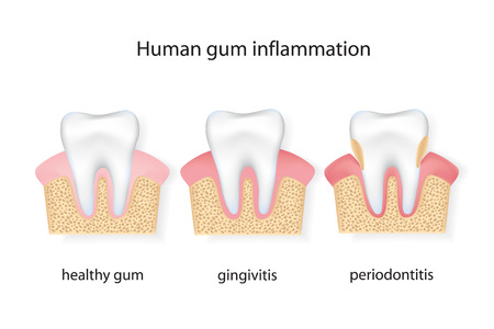Human gum inflammation. EPS 10 vector file.のイラスト素材