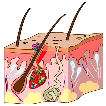 Skin section with hair and acne with cartoon germsのイラスト素材