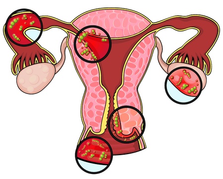Section of female reproductive system and germs on different partsのイラスト素材