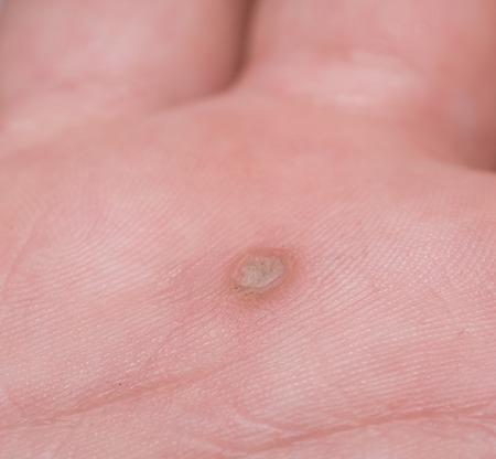 Common wart Verruca vulgaris also known as HPVの写真素材