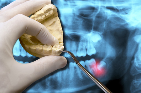 molar and wisdom tooth painの写真素材