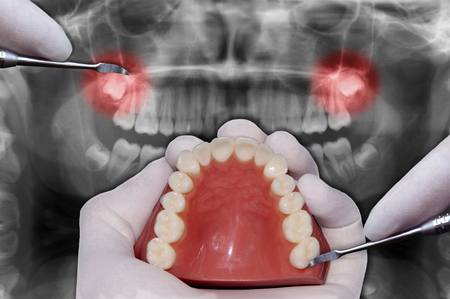 surgical orthodontic operationの写真素材