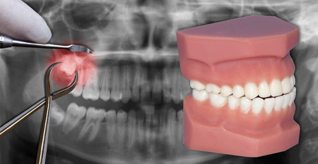 surgical tooth extractionの写真素材
