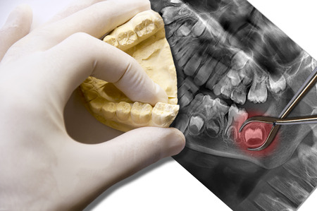 dentist tooth extraction simulatesの写真素材
