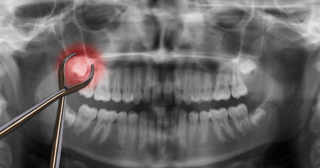 extraction wisdom tooth over the dental scanの写真素材