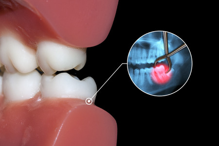 surgical tooth extraction operationの写真素材