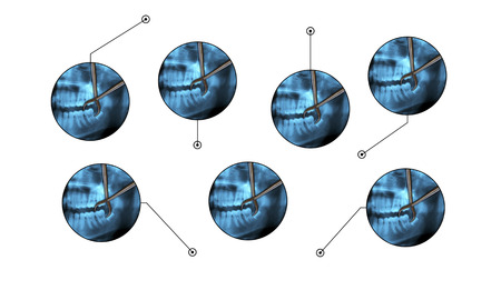 extraction wisdom tooth over radiographyの写真素材