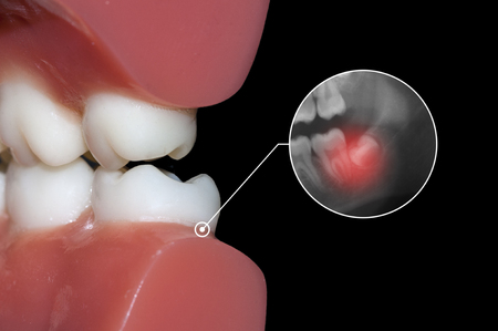 wisdom tooth toothacheの写真素材