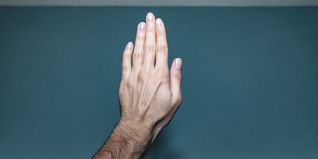 Shot of a white caucasian manâs left hand with a broken pinky finger that hasnât healed properly, and a ganglion cyst lump lodged between the dorsal digital nerves of ulnar nerve. 
の写真素材