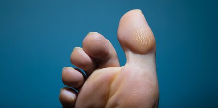 Extreme close up of athlete foot fungus infection seen from belowの写真素材