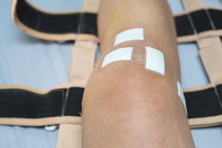 Leg of pcl ligament knee surgery patient lying on bed in ward at hospital with sterile bandage plaster on wound.の写真素材