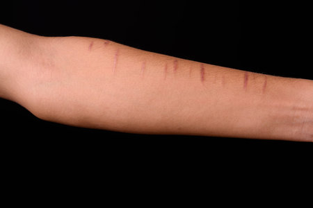 Arm of young Indian man with cuts on wrist