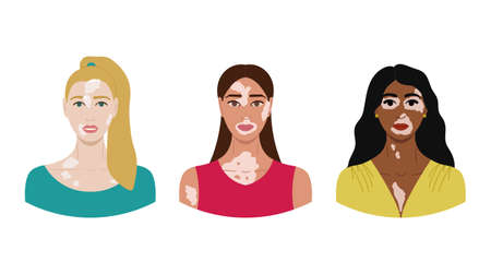 Set of female faces with vitiligo. World Vitiligo Day. Collection of portraits of women with different skin color and hairstyles. Body positive concept. Hand drawn vector illustration.のイラスト素材