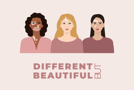 Female faces with vitiligo skin disease banner. Different but beautiful concept. Portraits with different ethnics, skin colors, hairstyles with vitiligo. body positive. flat vector illustrationのイラスト素材