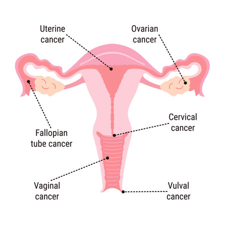 Gynecological Cancer Awareness Month infographic. Main types of cancer cervical, ovarian, uterine, vaginal and vulvar in woman's reproductive organs. Cancer prevention, women health illustrationのイラスト素材