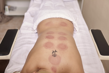red vacuum spots, dry cupping therapy, on woman back.の写真素材