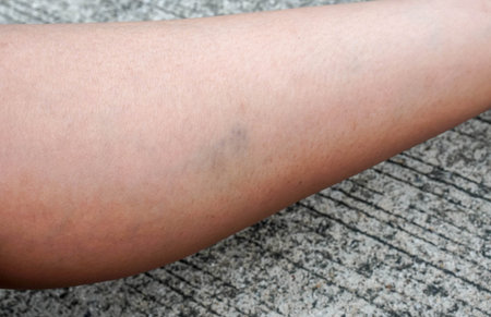 selective focus woman left leg with bruise pain