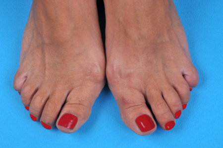 Close-up of feet with hallux valgus on blue background