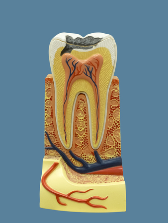 Tooth model with caries. Isolated on blue background.の写真素材