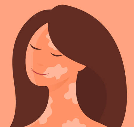 Illustration of a beautiful young woman with vitiligoのイラスト素材