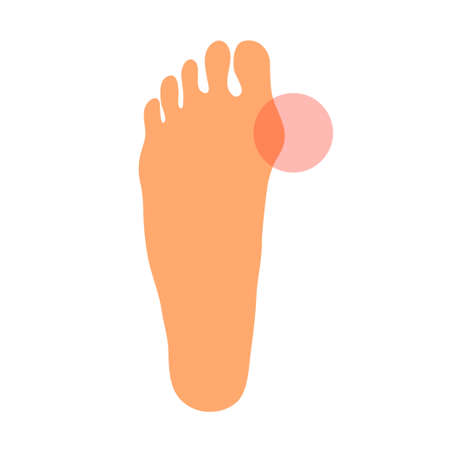 Hallux valgus problem on the leg. Orthopedic deformity of the joint and bone. Women foot. disease, pain and healing. health care. Vector illustration infographic isolated on white backgroundのイラスト素材