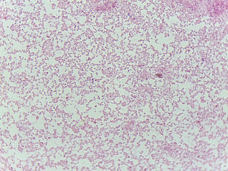 Microscopic Field of Red/Pink Bacteria Clustered in Colonies, Suggesting a Gram-Negative Stain