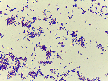 Microscopic Field of Dense, Clumped Bacilli (Rod-Shaped Bacteria) After Gram Staining