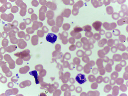 Microscopic View of a Blood Smear Highlighting Leukocytes and Red Blood Cells