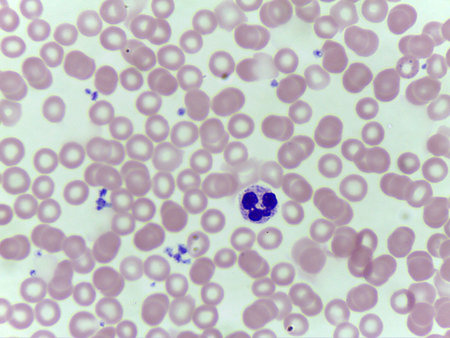 Blood smear showing white and red blood cellsの写真素材