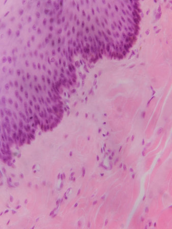 Microscopic view of tissue with purple and pink staining, showing cellular structures and patterns,...
