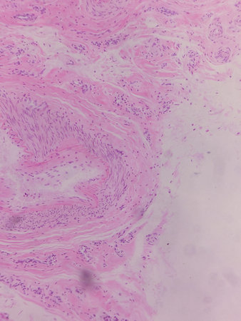 Acne in human skin. Acne in the human body.の写真素材