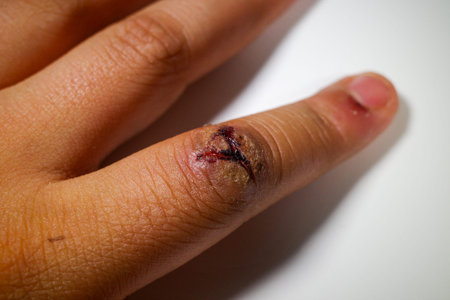 A close-up of a hand with a healing wound on the finger, showing signs of bruising and scabbing. The skin appears slightly swollen around the injury, indicating recent trauma.のeditorial素材