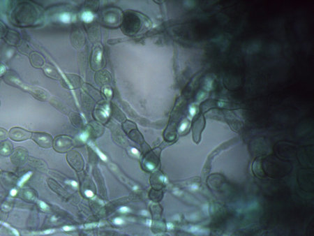 Micrograph showing intertwined septate and dematiaceous fungal hyphae in a dense network.