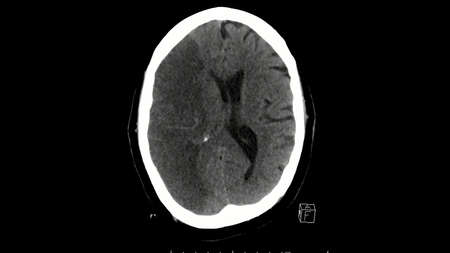 Computed tomography scan of the brain axial cut showing massive right middle cerebral artery infarctionの写真素材