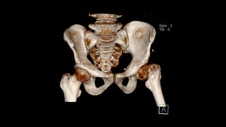 Computed Tomography Volume Rendering examination of the  pelvis showing left femur neck fracture ( CT VR Pelvis). 3D renderingの写真素材