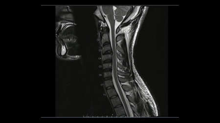 Magnetic Resonance images of Cervical spine sagittal T2-weighted images  (MRI Cervical spine) showing mild disc disease.の写真素材