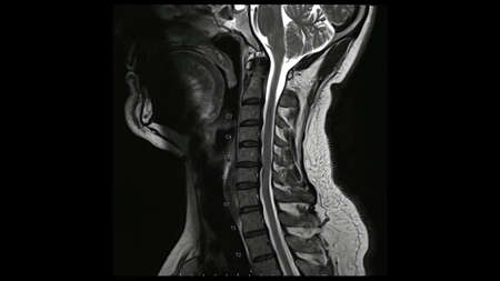 Magnetic Resonance images of Cervical spine sagittal T2-weighted images (MRI Cervical spine) showing Multiple disc disease, more evident at C5-6 disc.の写真素材